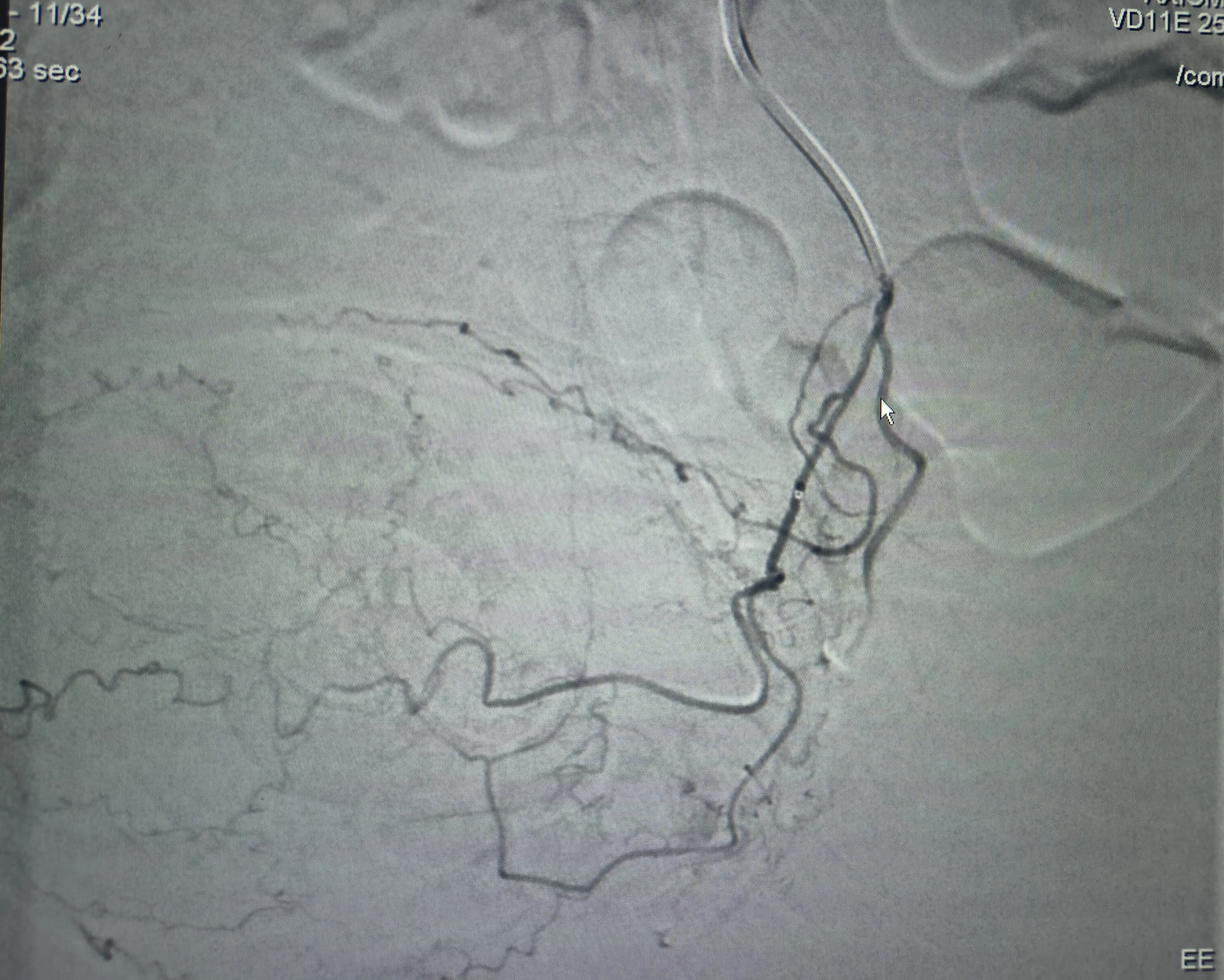 Left Prostatic Artery from the Left Superior Vesical Artery